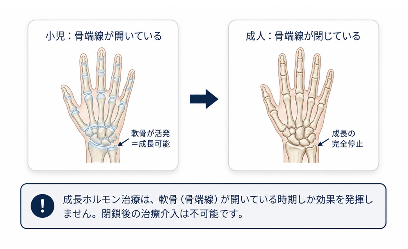 小児の開いた骨端線と成人の閉じた骨端線を比較した説明図